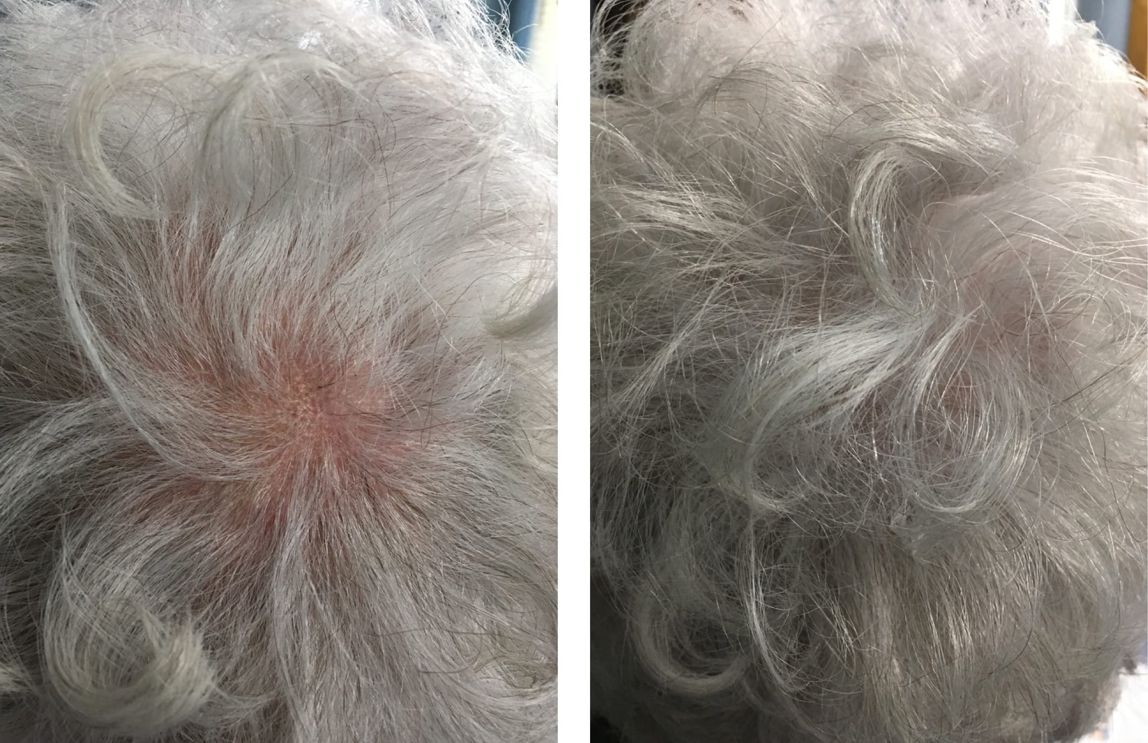 Caboki hair fiber conceals bald spot for a fuller-looking scalp