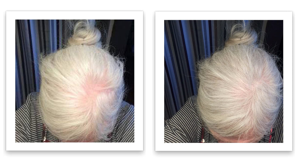 Caboki hair fiber sparse-hairline close-up emphasizes natural finish