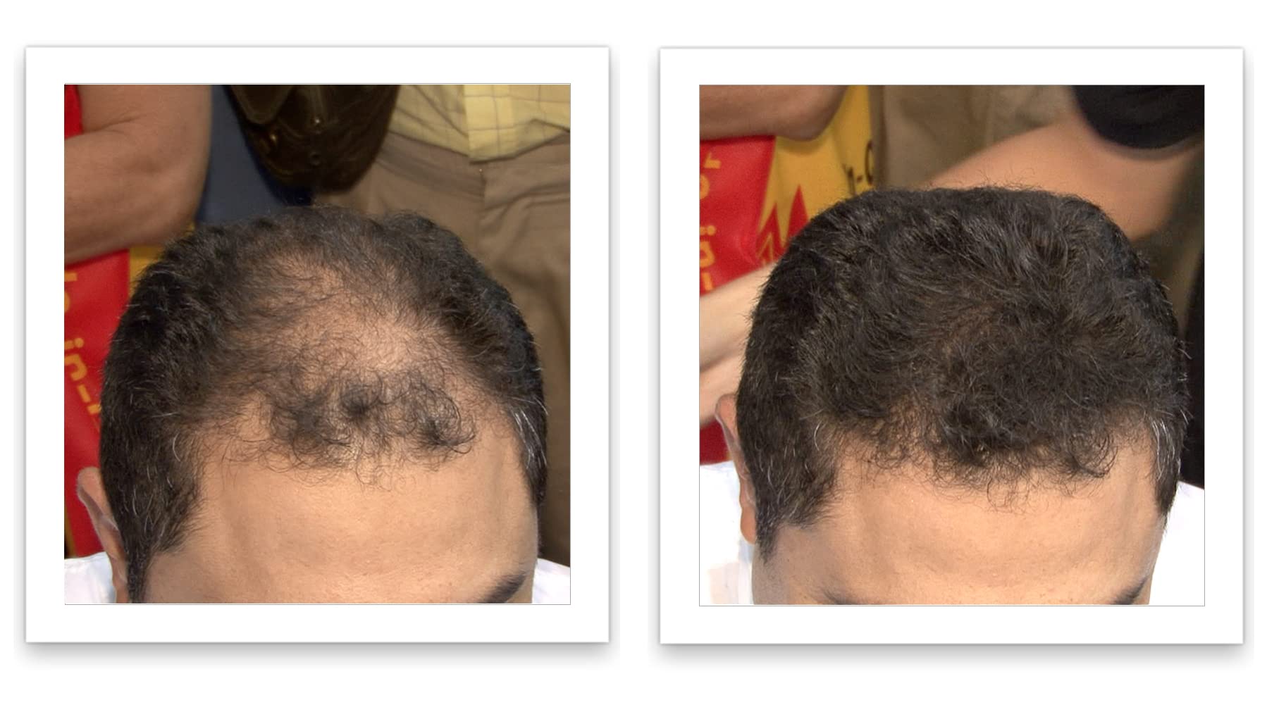 Applying Caboki with gentle patting to set fibers for a fuller look.