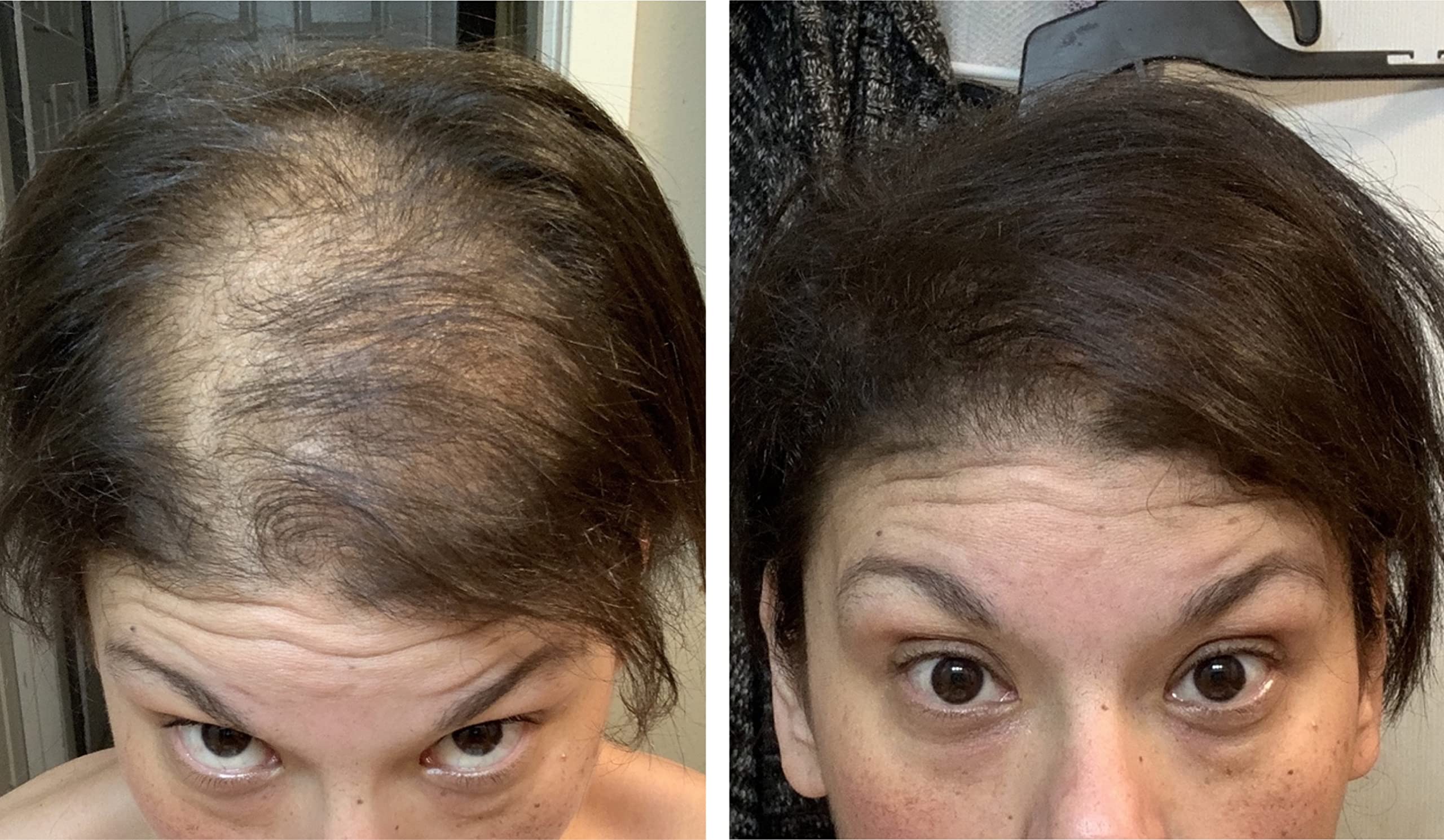 On dry hair, Caboki provides quick, noticeable coverage during daily routines.