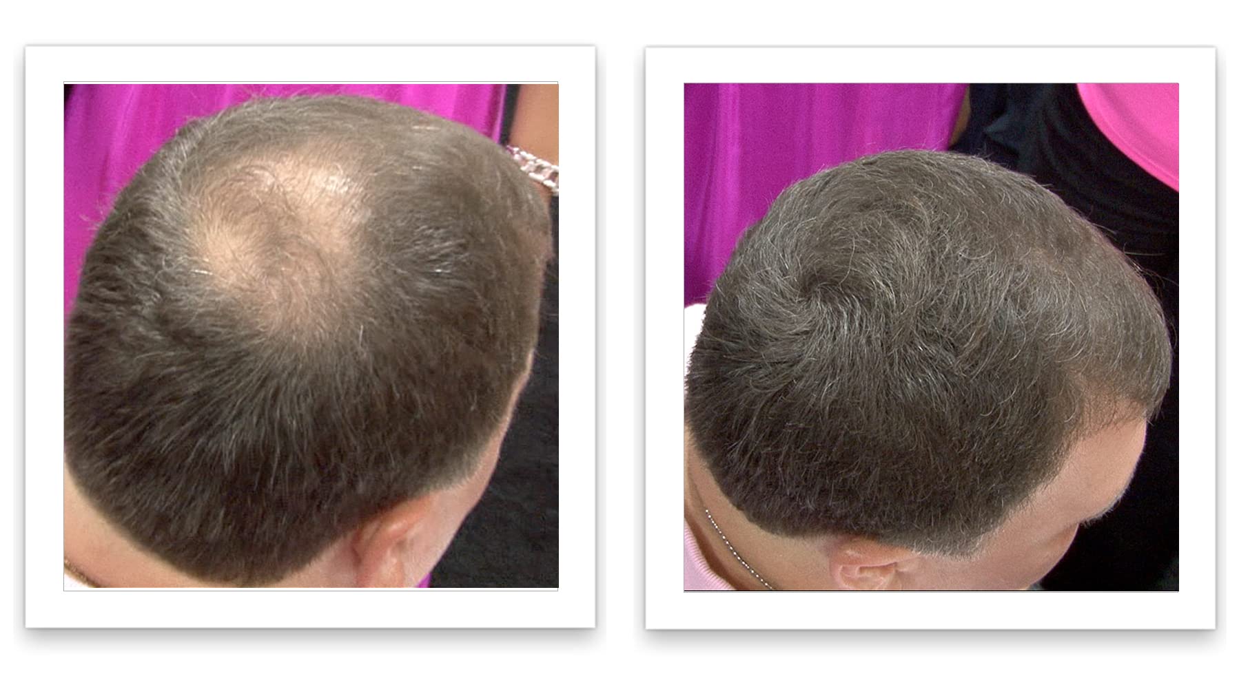 Caboki thinning-area-after shows a fuller-looking appearance using natural-looking fibers.