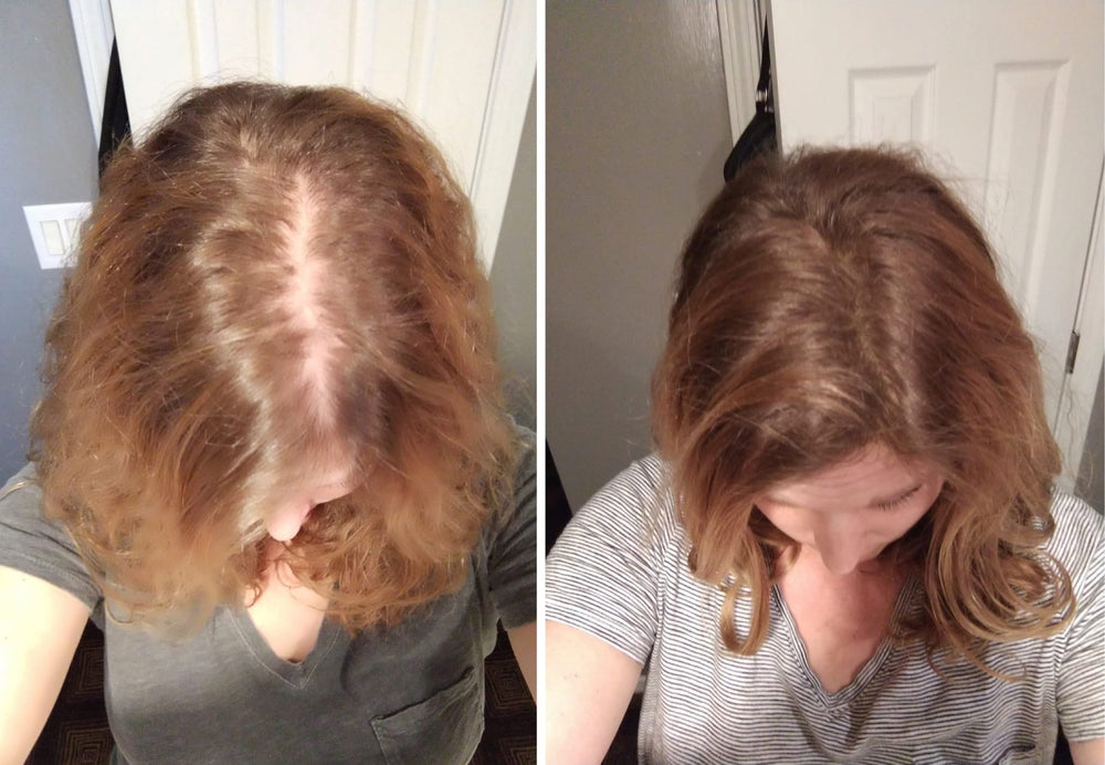 Caboki thinning-area-before image highlights sparse hair on crown.