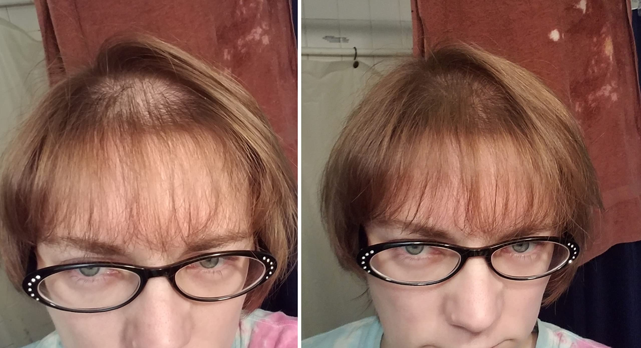 Caboki thinning hair before shot highlights sparse strands and visible scalp.