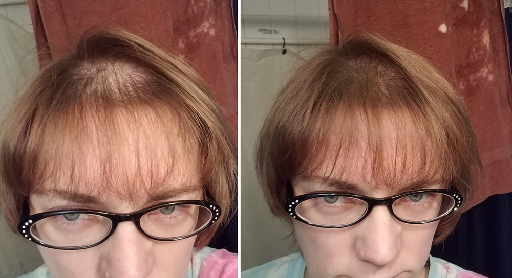 Caboki thinning hair before shot highlights sparse strands and visible scalp.