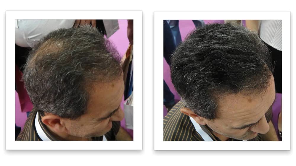 Caboki thinning hair fuller look demonstrates dramatic visual enhancement.