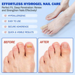 Cacukn toenail patch application on nail demonstrates secure overnight adhesion for effective treatment.