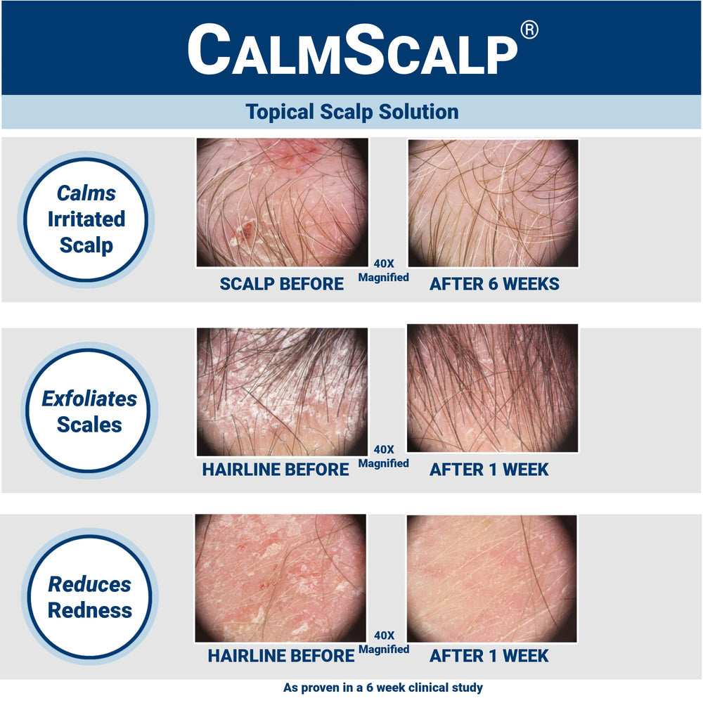 CalmScalp serum being applied along the hairline for relief from itching.