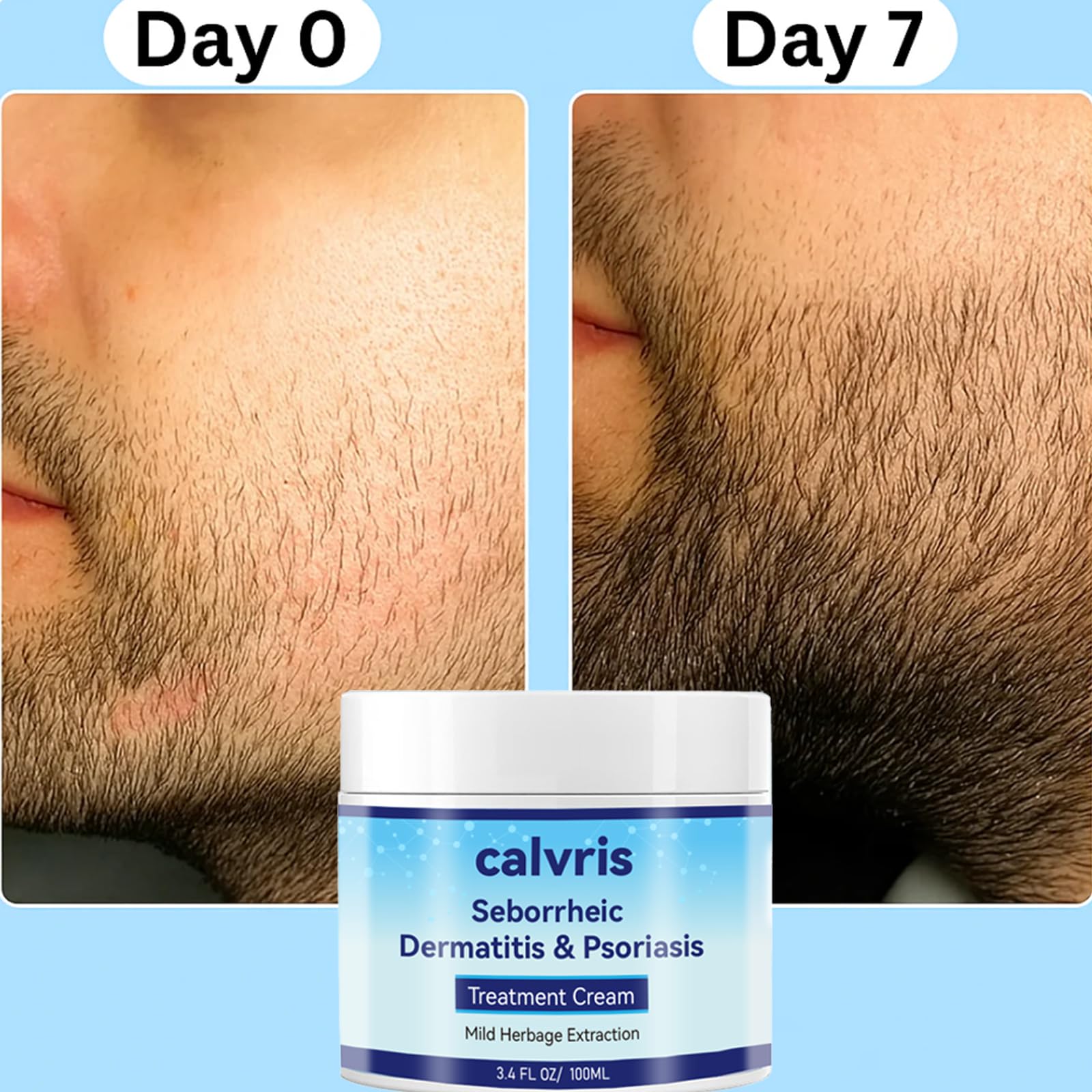 Calvris Scalp Comfort Balm applying scene demonstrates cooling sensation