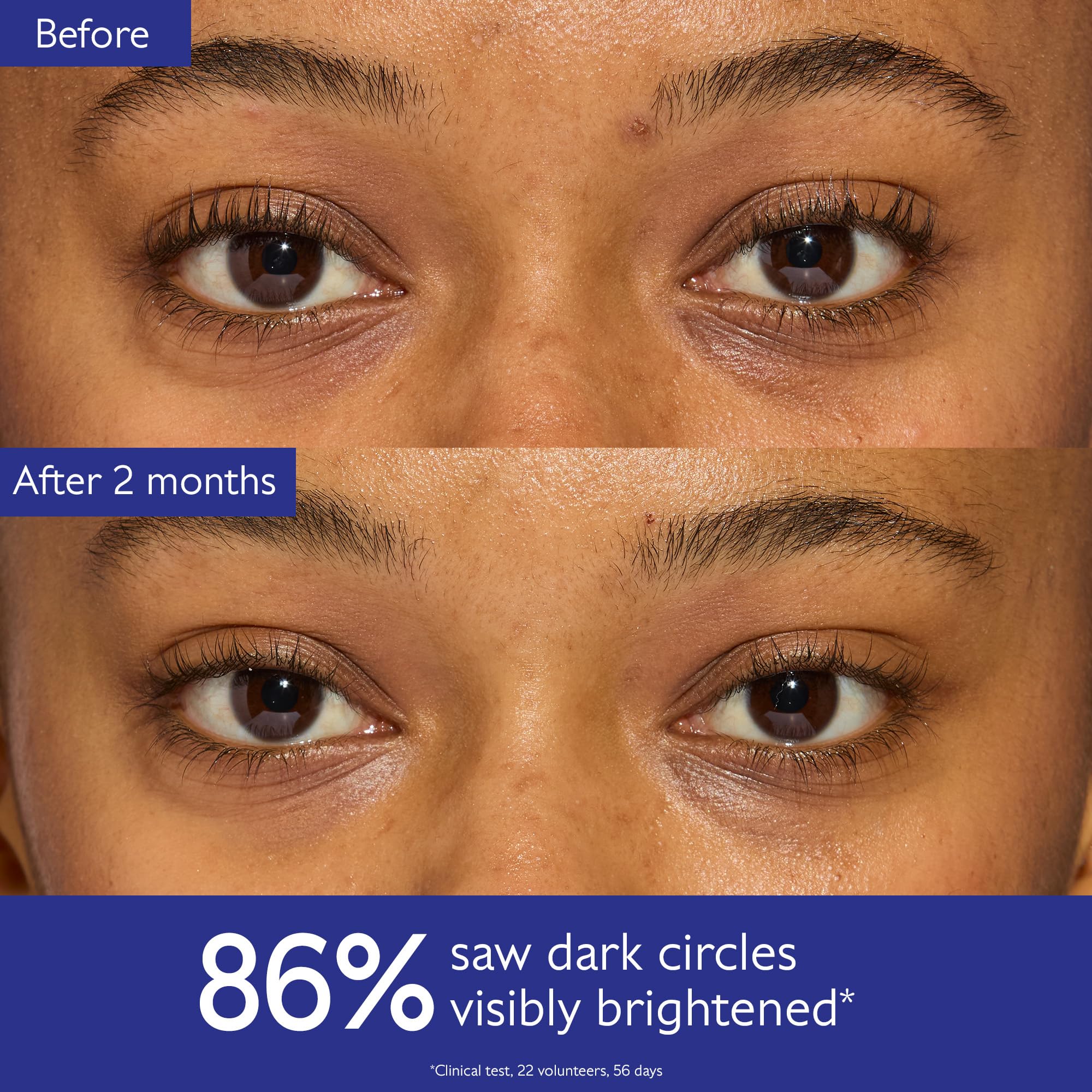 Caudalie Vinoperfect eye contour close-up highlighting brightened under-eye area and even texture.
