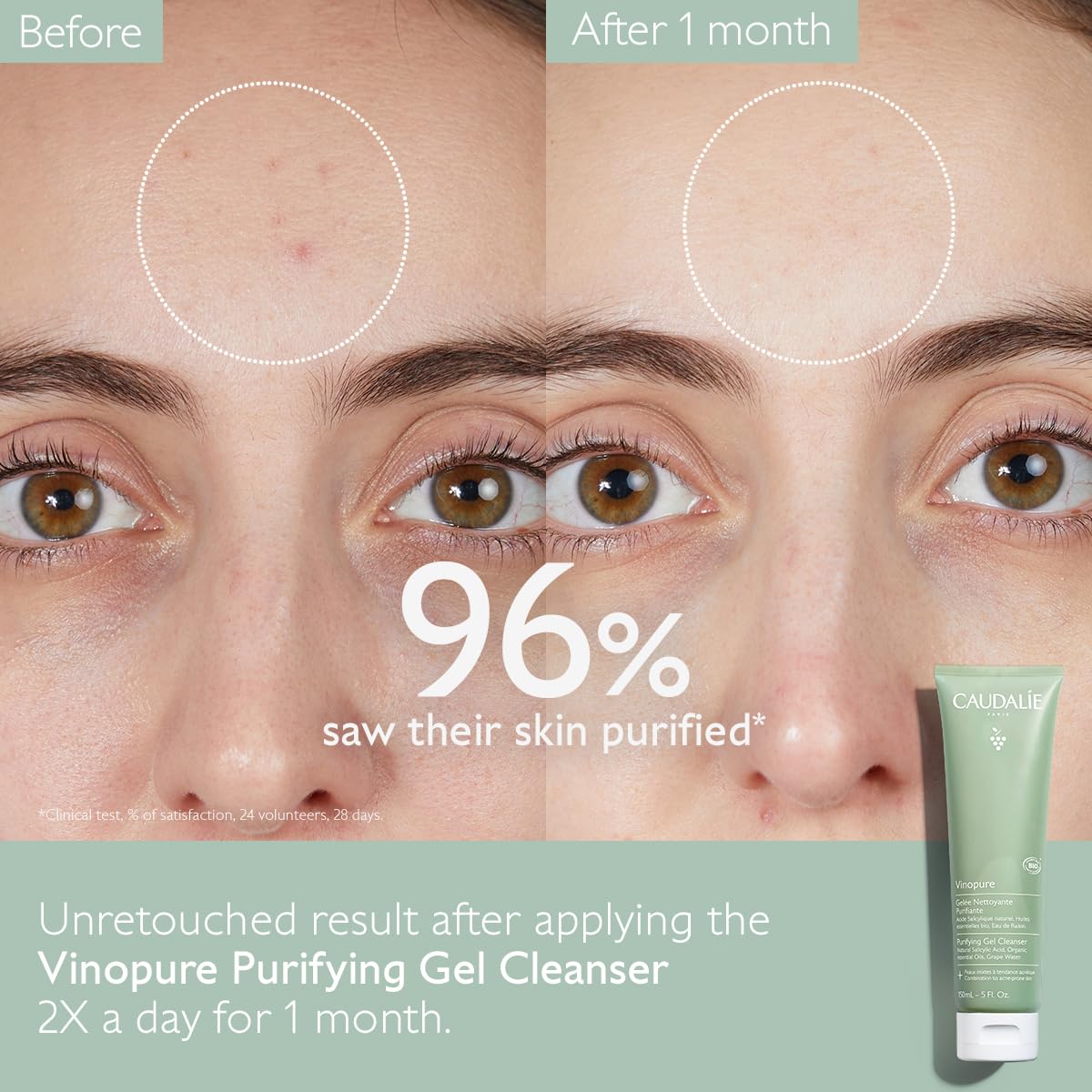 Caudalie Vinopure exfoliation closeup emphasizes salicylic acid action on dull skin.