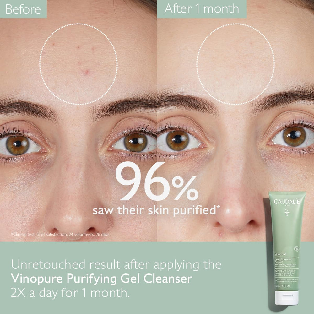 Caudalie Vinopure exfoliation closeup emphasizes salicylic acid action on dull skin.