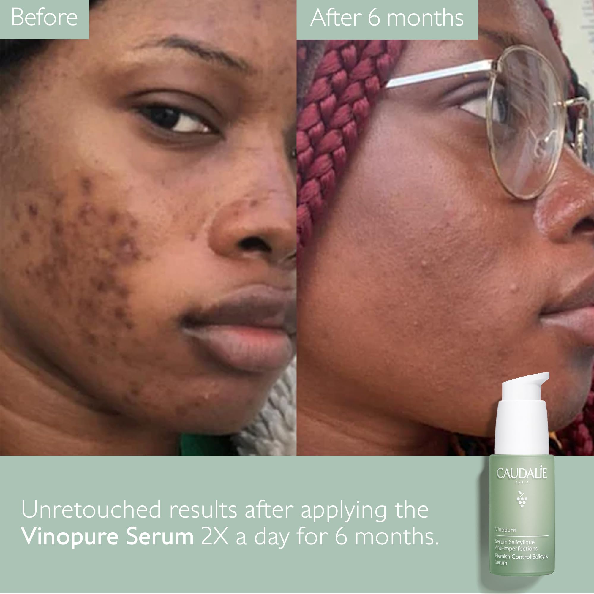 Caudalie Vinopure blemish-zap depiction emphasizing clear skin potential.