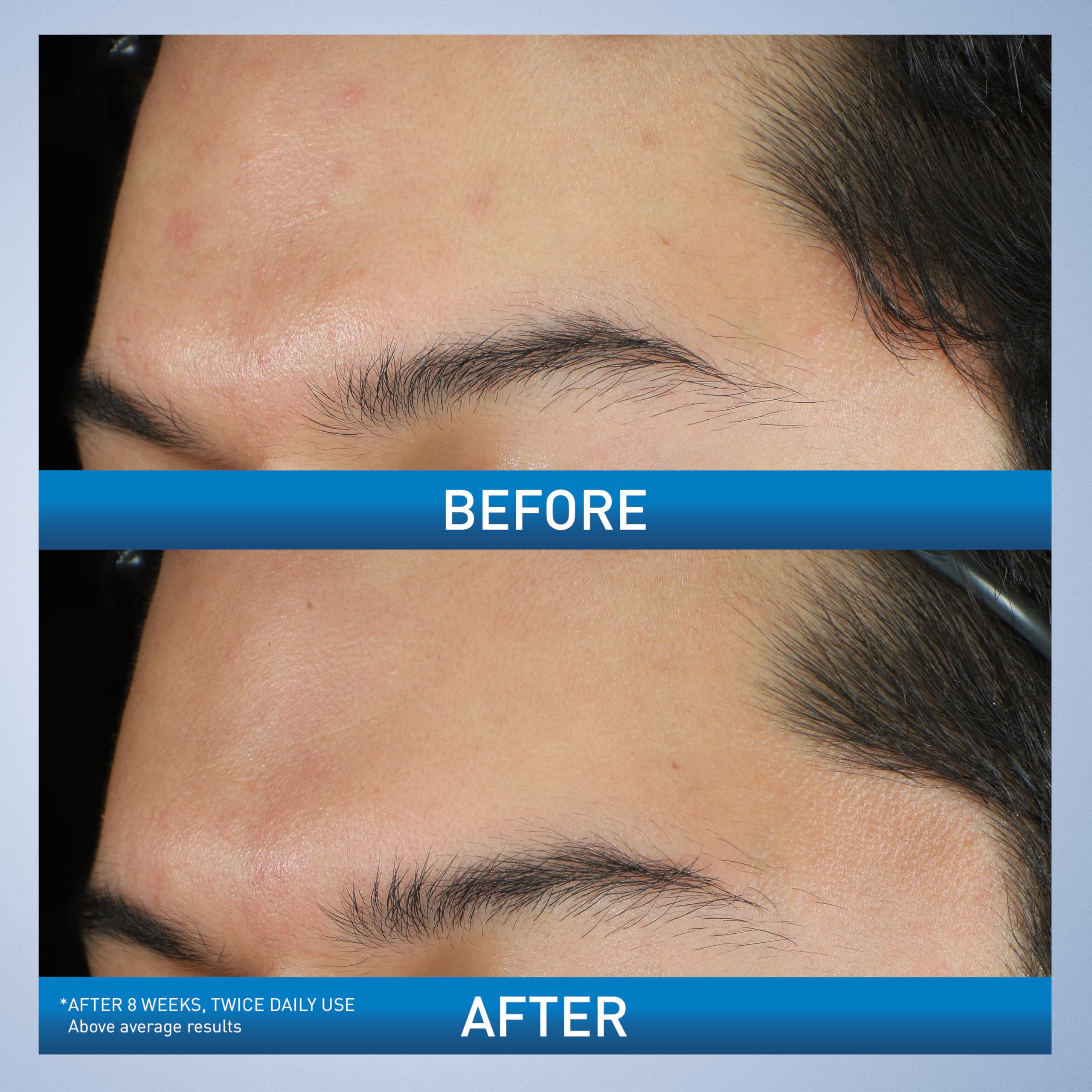 CeraVe product label highlighting active 10% benzoyl peroxide