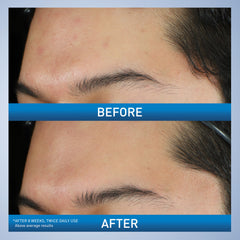 CeraVe product label highlighting active 10% benzoyl peroxide