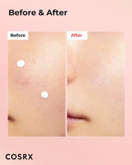 COSRX lotion drops on skin provide precise spot treatment for whiteheads.
