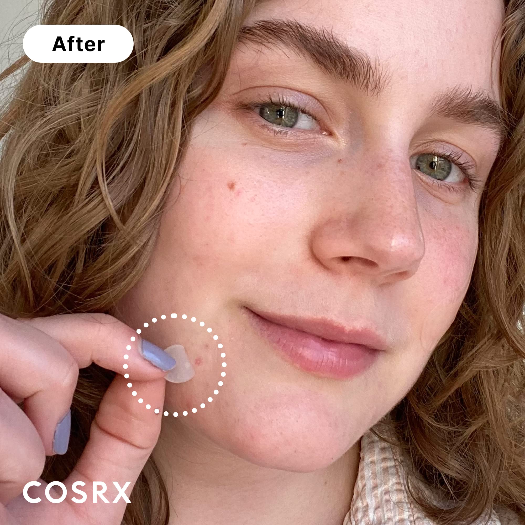 COSRX Acne Pimple Patch on blemish provides protective coverage and soothing spot care