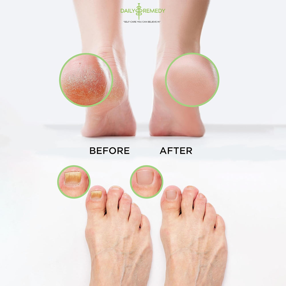 Daily Remedy foot soak with Epsom salts eases soreness.