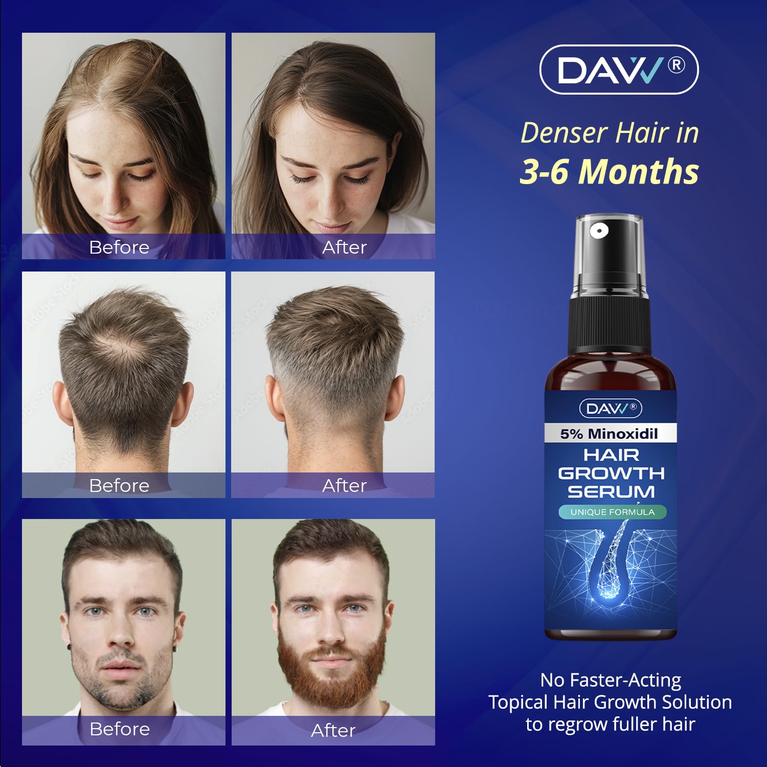 DAVV Minoxidil spray applied to the scalp for targeted growth.