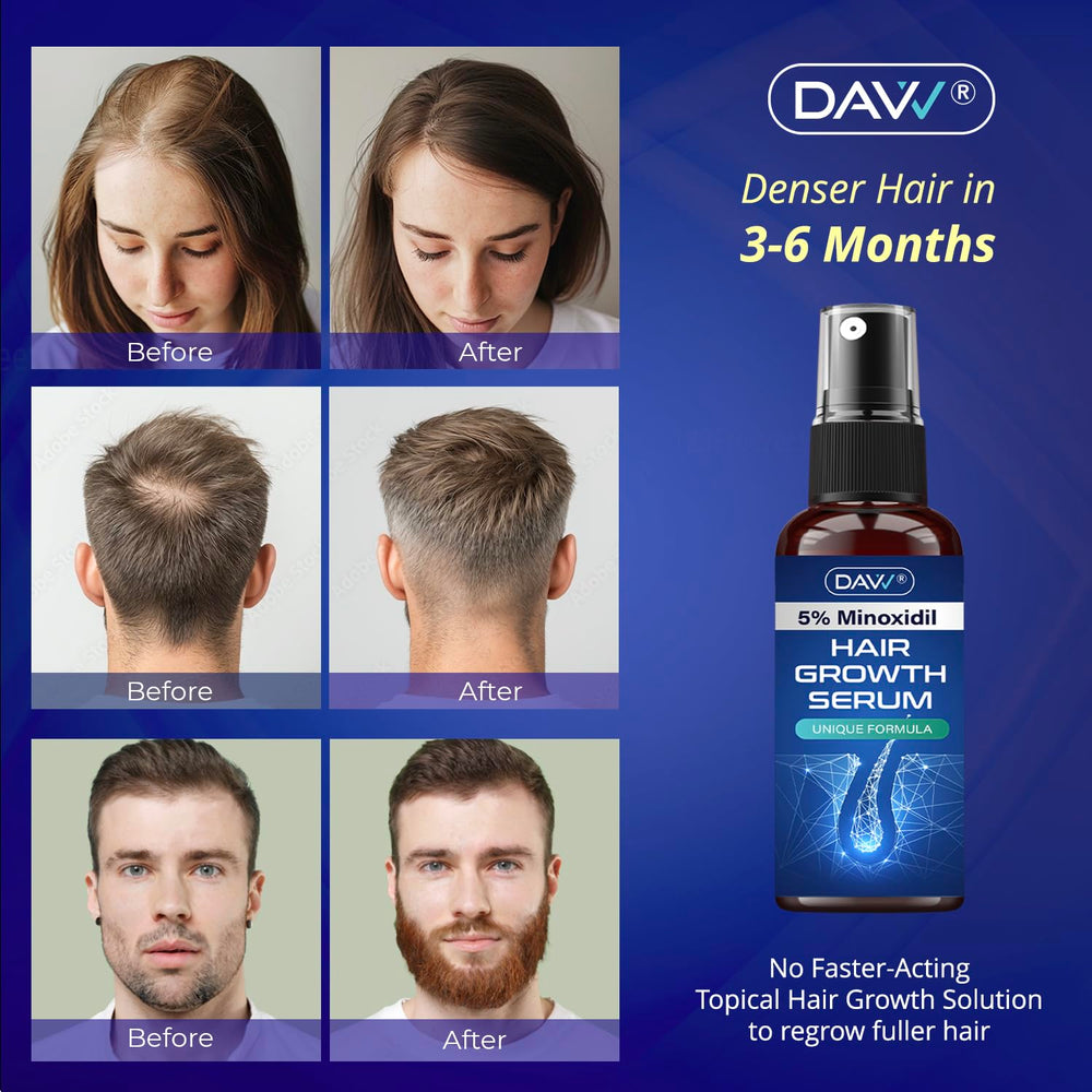 DAVV Minoxidil spray applied to the scalp for targeted growth.