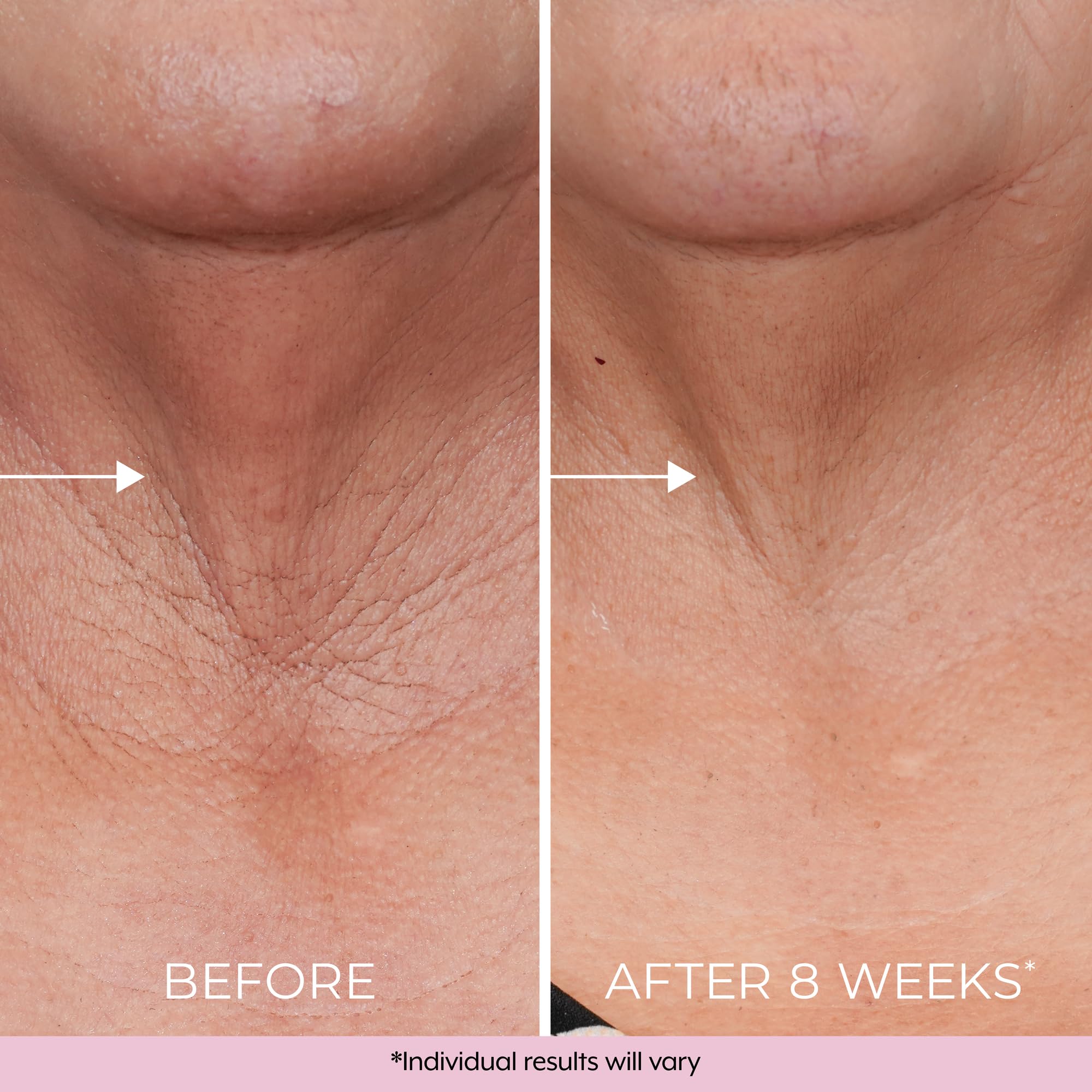 Dekliderm Neck Firming Cream sagging close-up demonstrates possible neck firmness.
