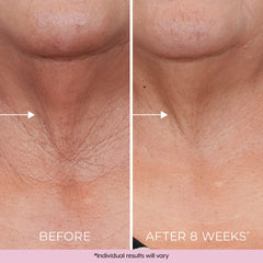 Dekliderm Neck Firming Cream sagging close-up demonstrates possible neck firmness.
