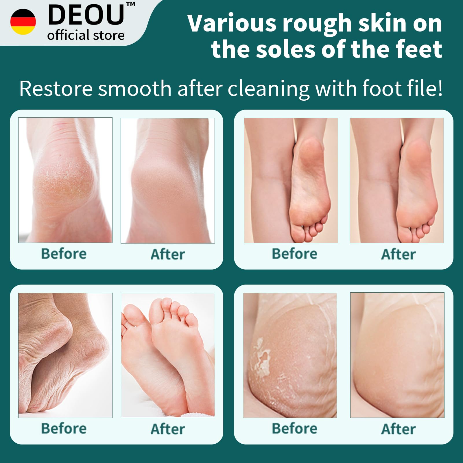 DEOU foot file surface with 315 micro blades for efficient exfoliation.