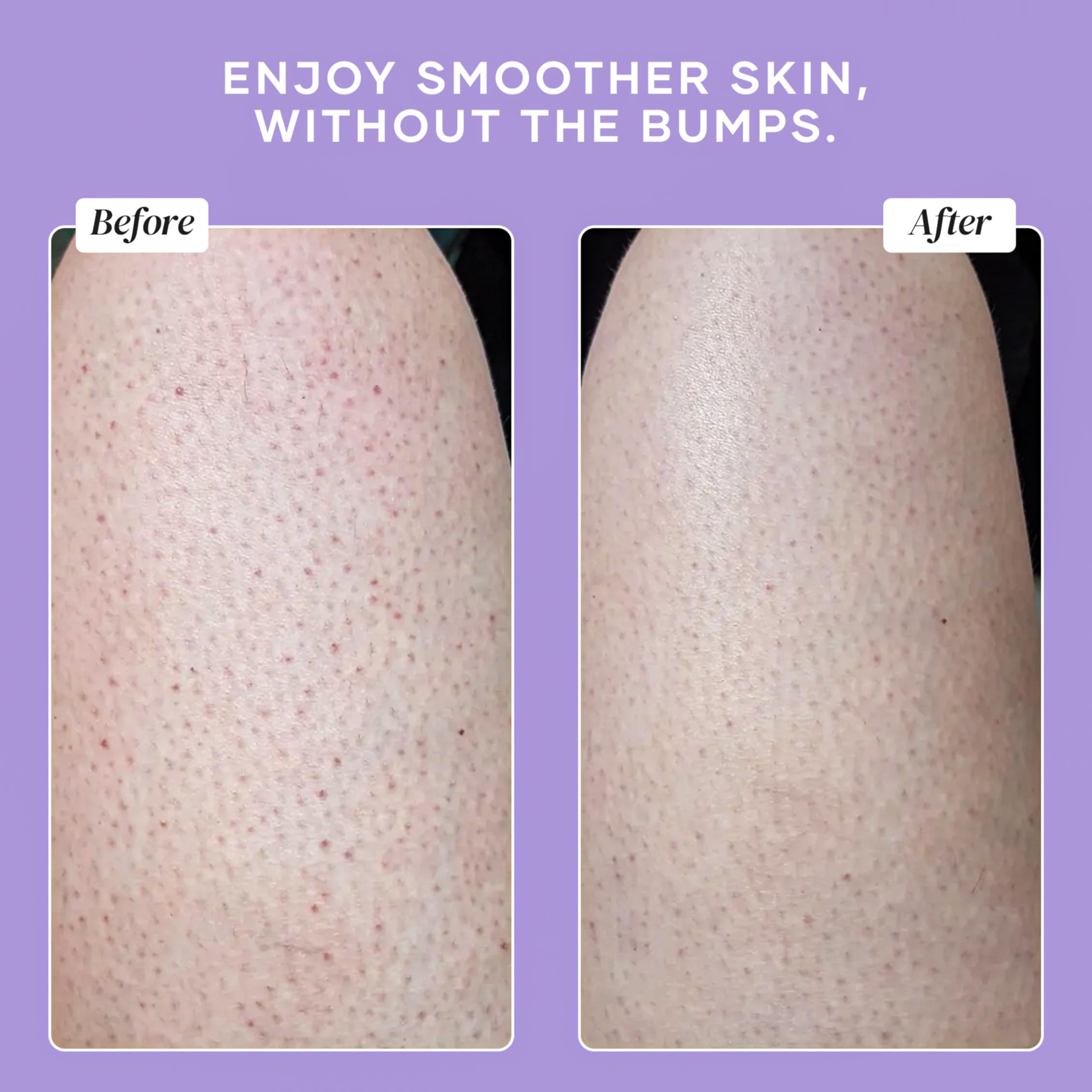 DERMAdoctor KP Bump Eraser dual-exfoliation — chemical and physical exfoliation in action