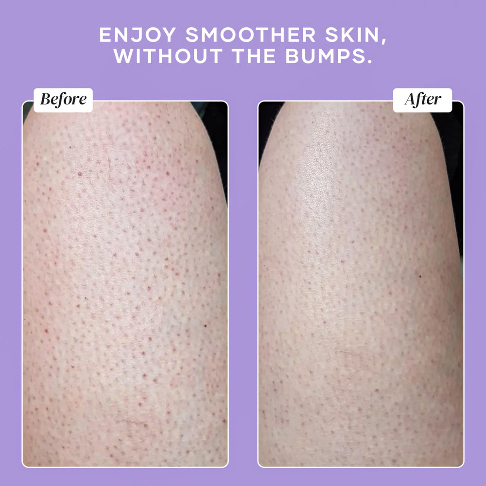 DERMAdoctor KP Bump Eraser dual-exfoliation — chemical and physical exfoliation in action