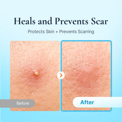 DERMAKR waterproof acne patch protecting skin during activity