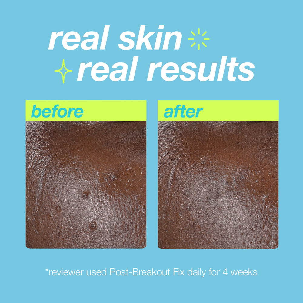 Dermalogica Clear Start salicylic acid action implies gentle exfoliation