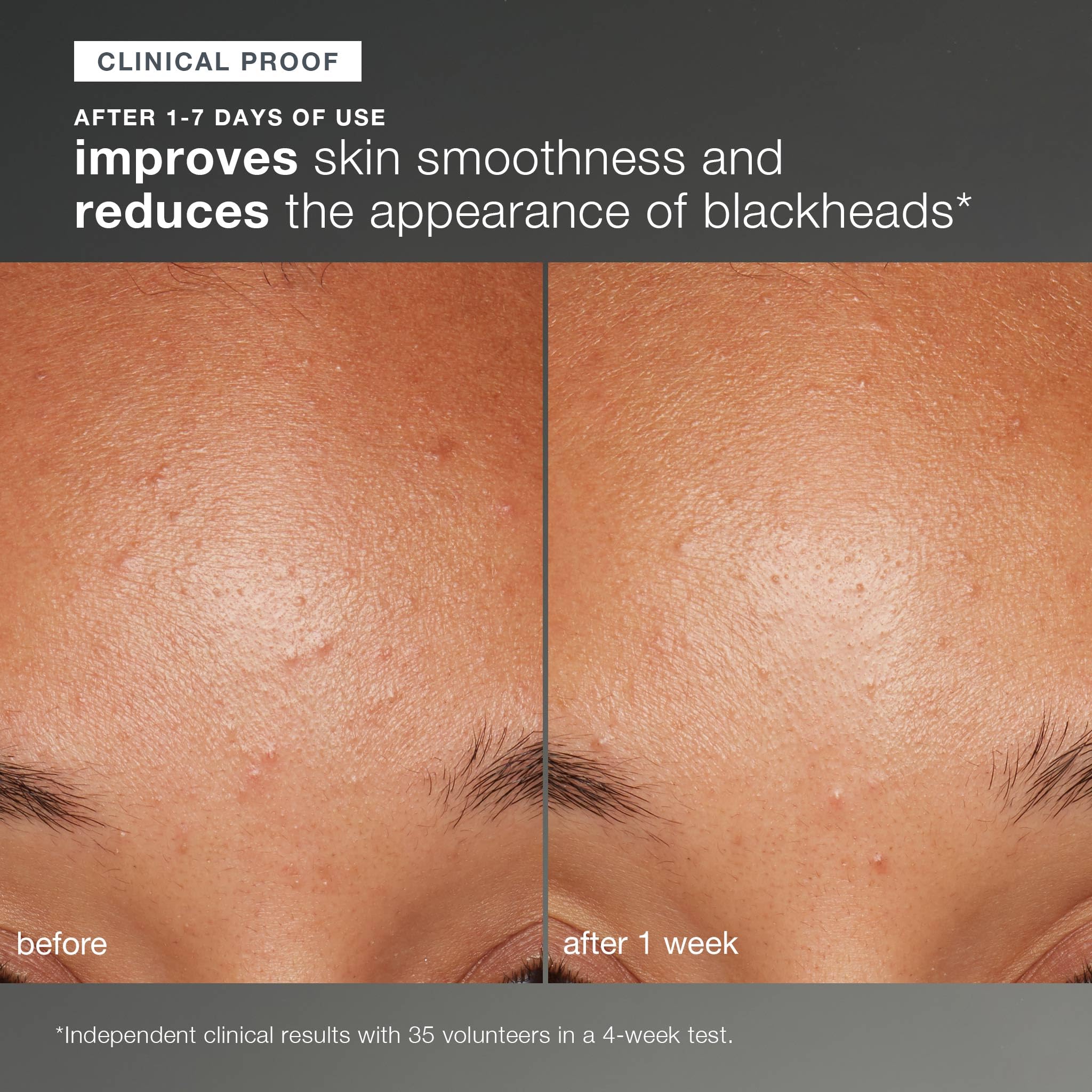 Dermalogica Daily Microfoliant creamy paste applied to the face for exfoliation.