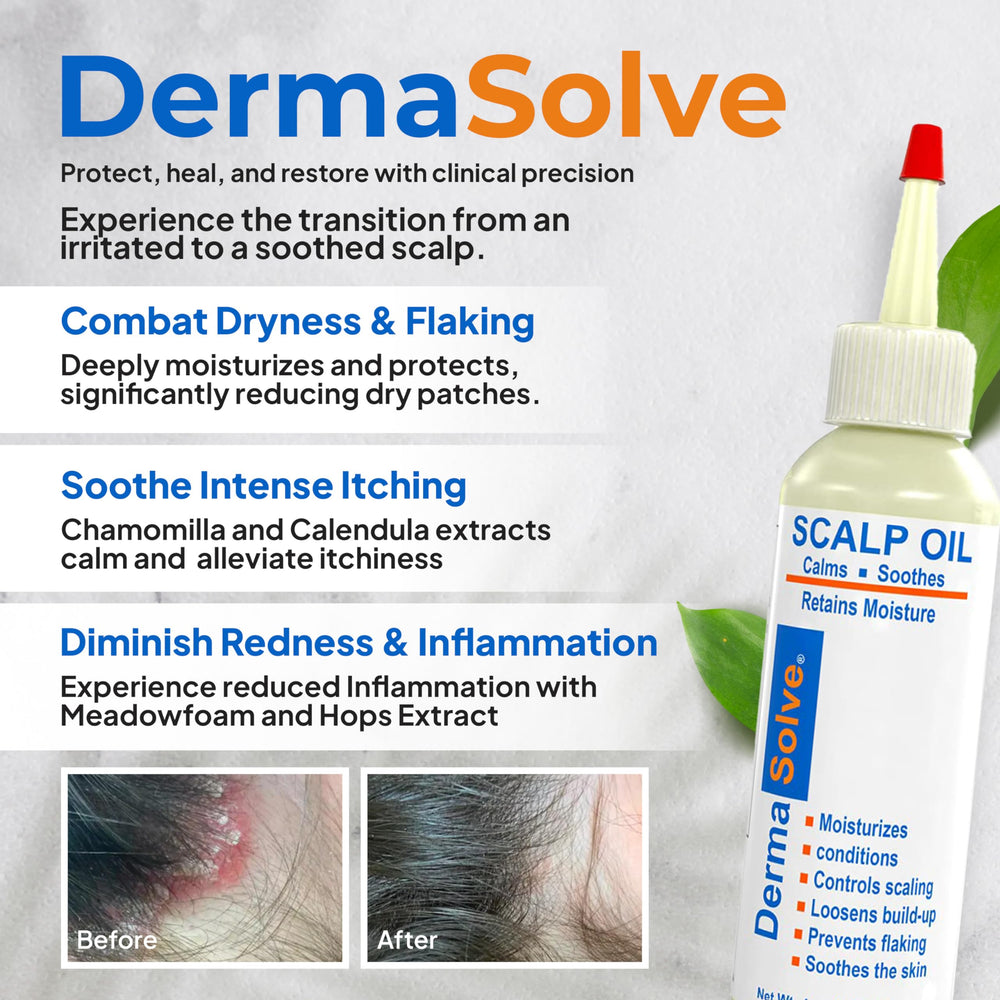 Dermasolve scalp oil dropper in hand for easy targeted application.