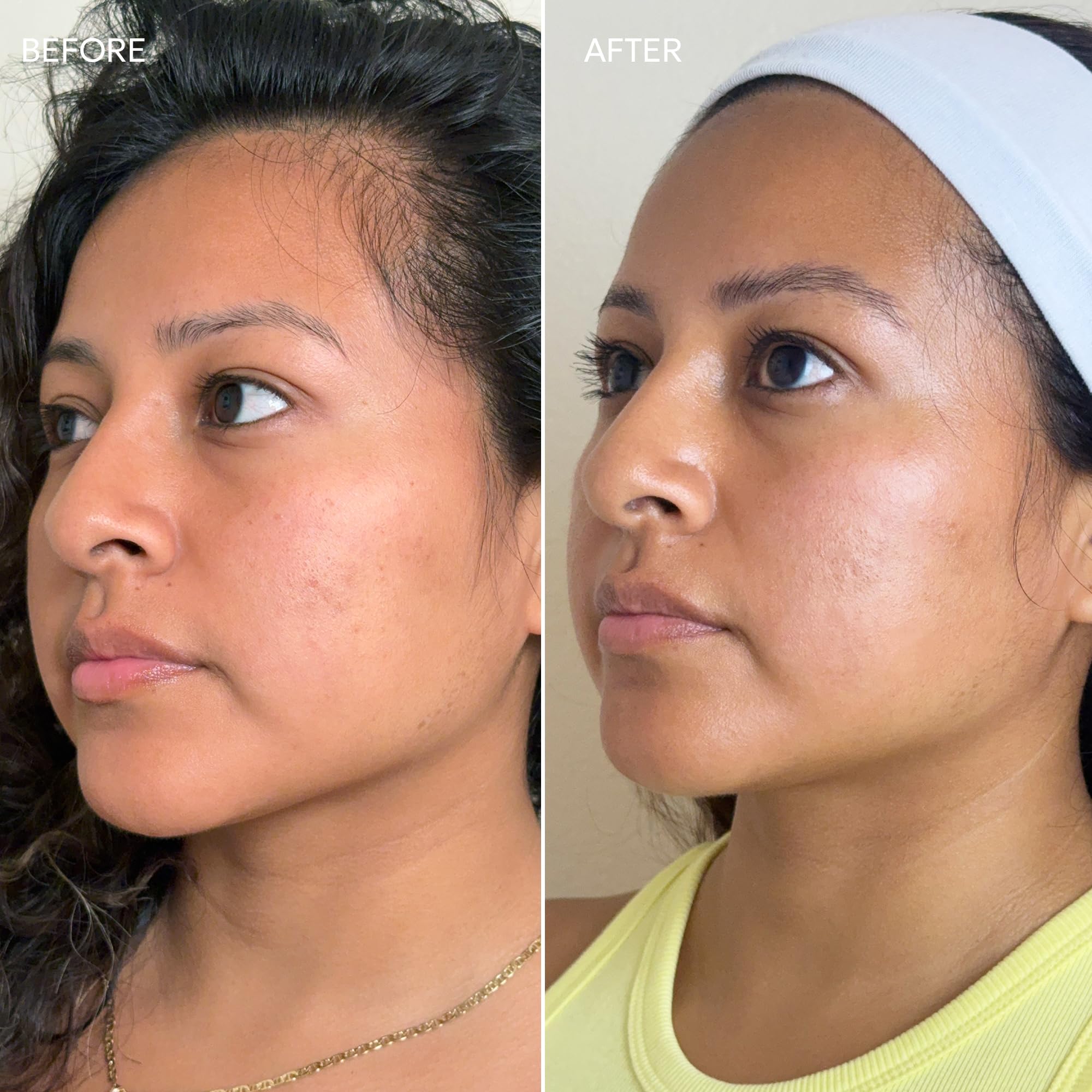 Dermisa before-after concept hints at spot fading over time.