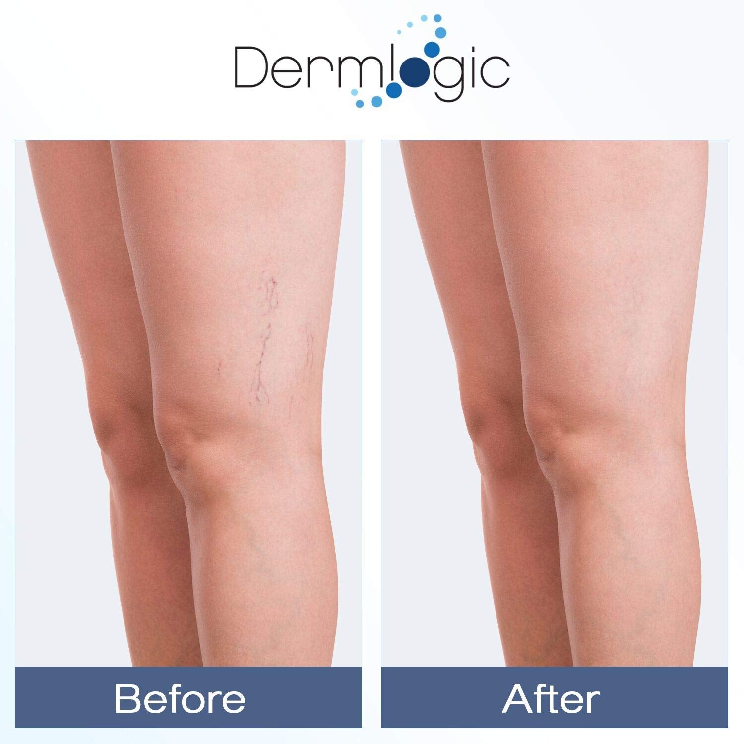 Dermlogic Vitamin K Cream spider-veins-use targets delicate skin with moisturized, even-toned results.
