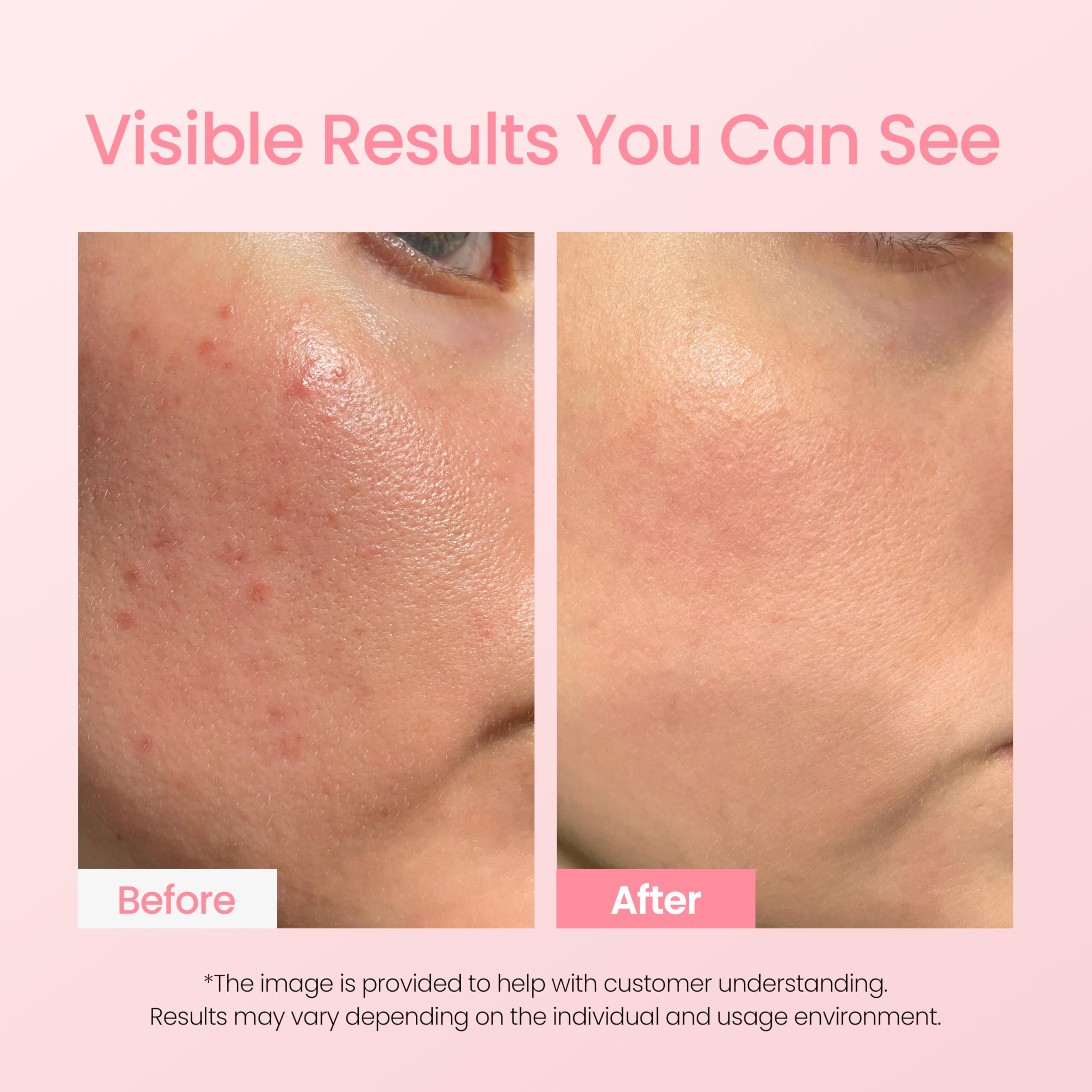 Azulene in NEOGEN A-Clear reduces redness and supports moisture barrier.