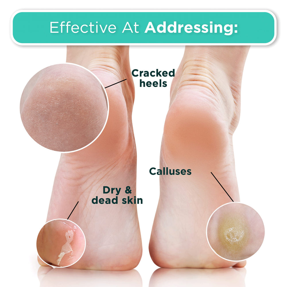 DERMORA Foot Peel Mask socks on feet demonstrates easy, mess-free treatment