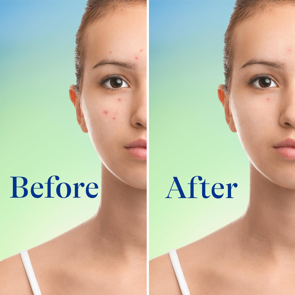 Differin used on back and chest showing body acne treatment benefit