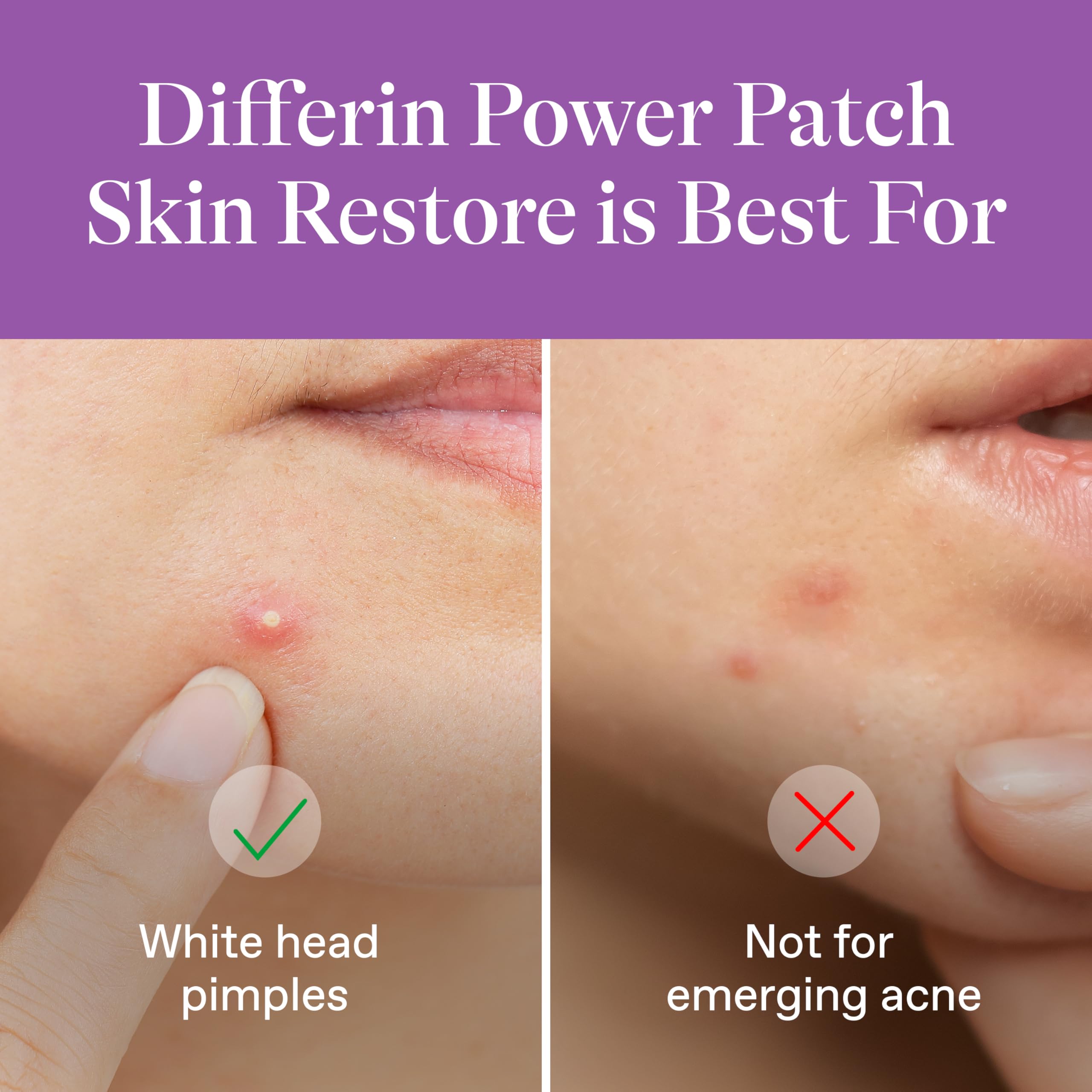 Differin close-up of patch texture highlighting hydrocolloid absorption benefit