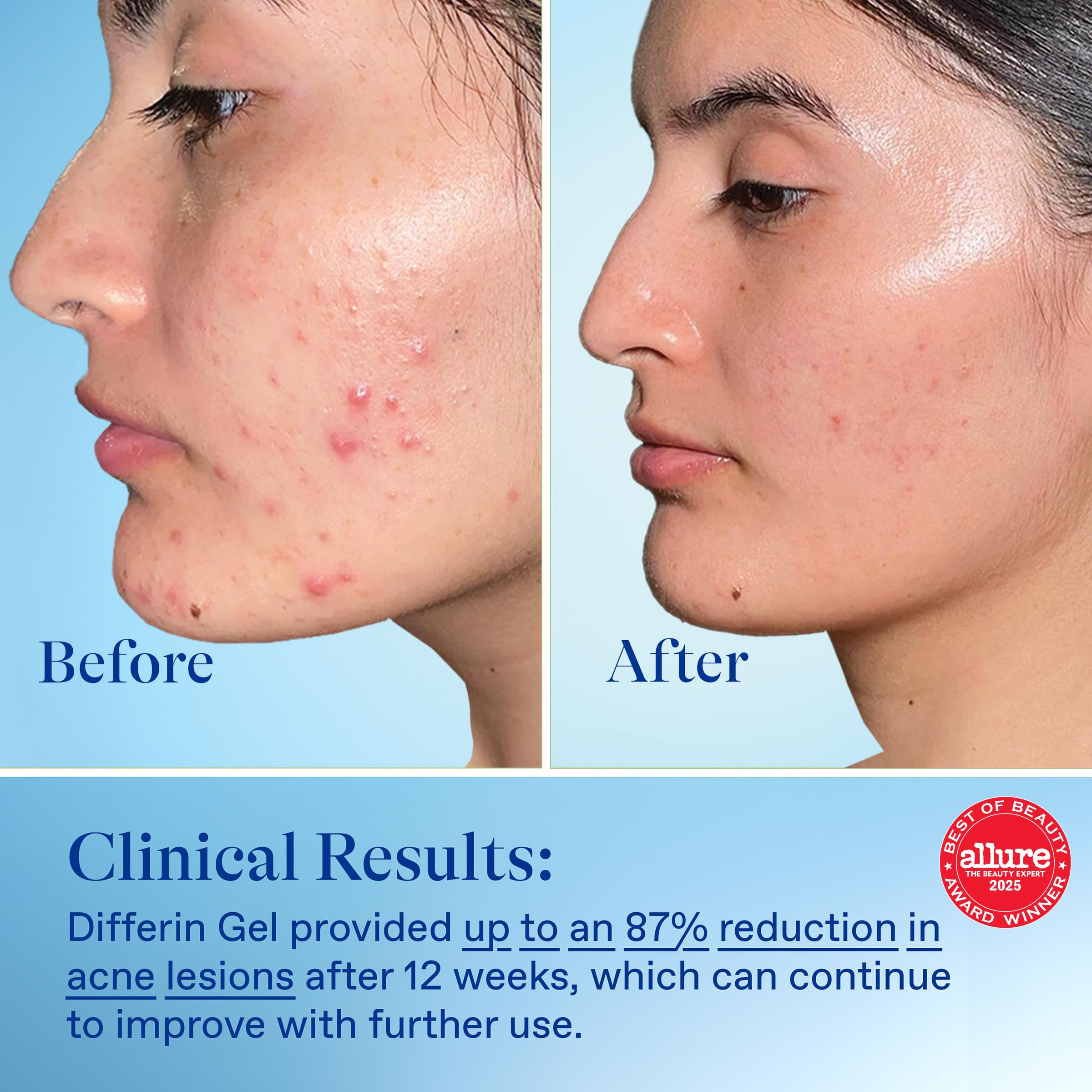 Differin product labeled fragrance-free for sensitive skin users