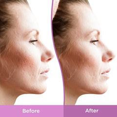 Applying Differin gel to cheek showing targeted spot treatment and visible smoothing benefit
