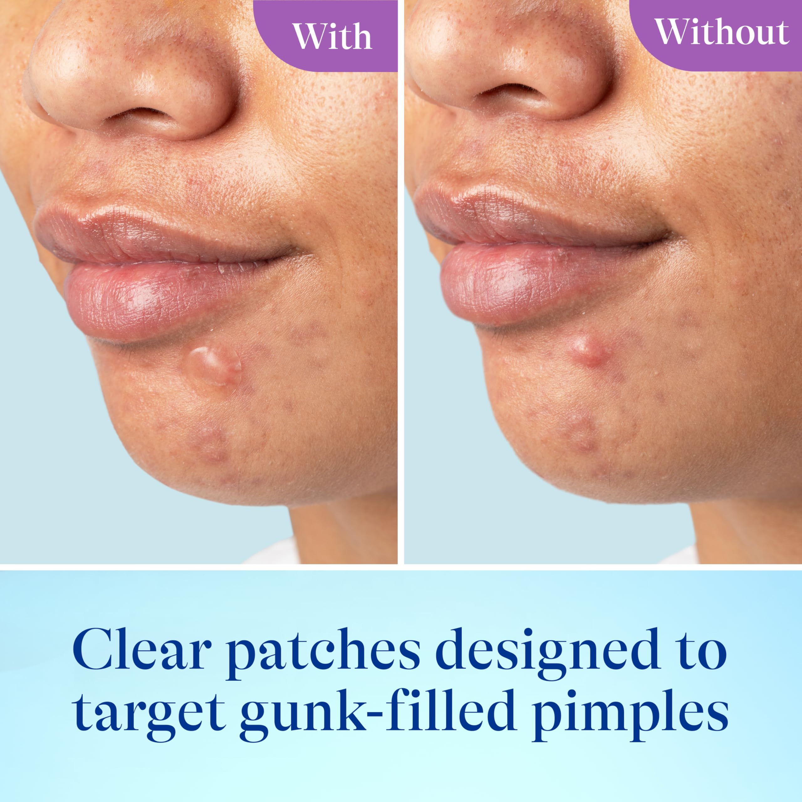 Differin small and large patches side-by-side showing size versatility benefit