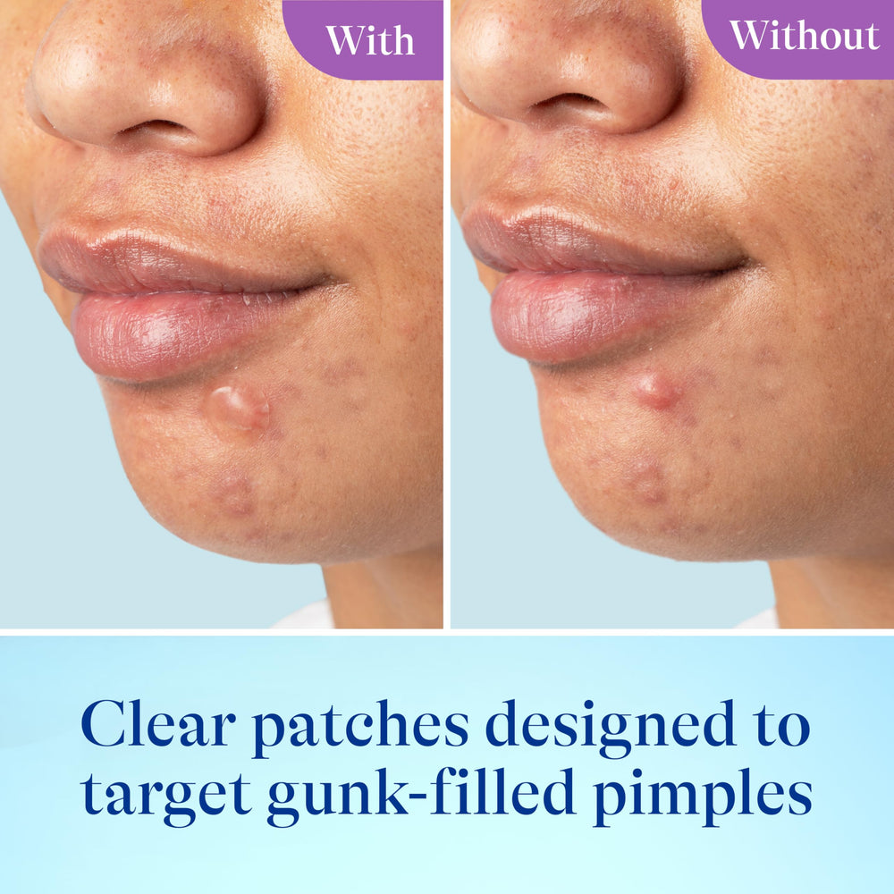 Differin small and large patches side-by-side showing size versatility benefit