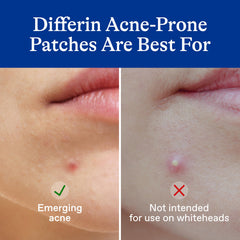 Differin salicylic acid texture close-up showing active exfoliating benefit