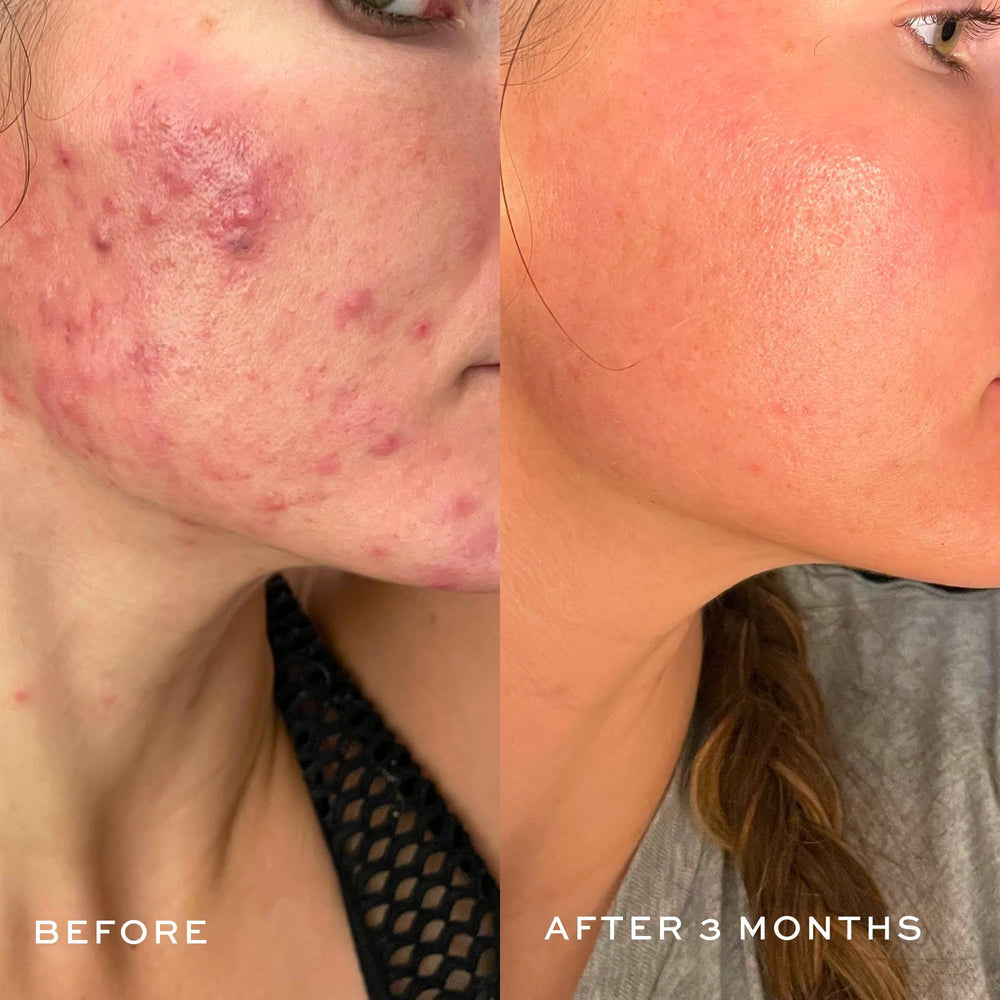 DIME Creamy Foam Cleanser near nose pores demonstrates salicylic acid cleansing effect