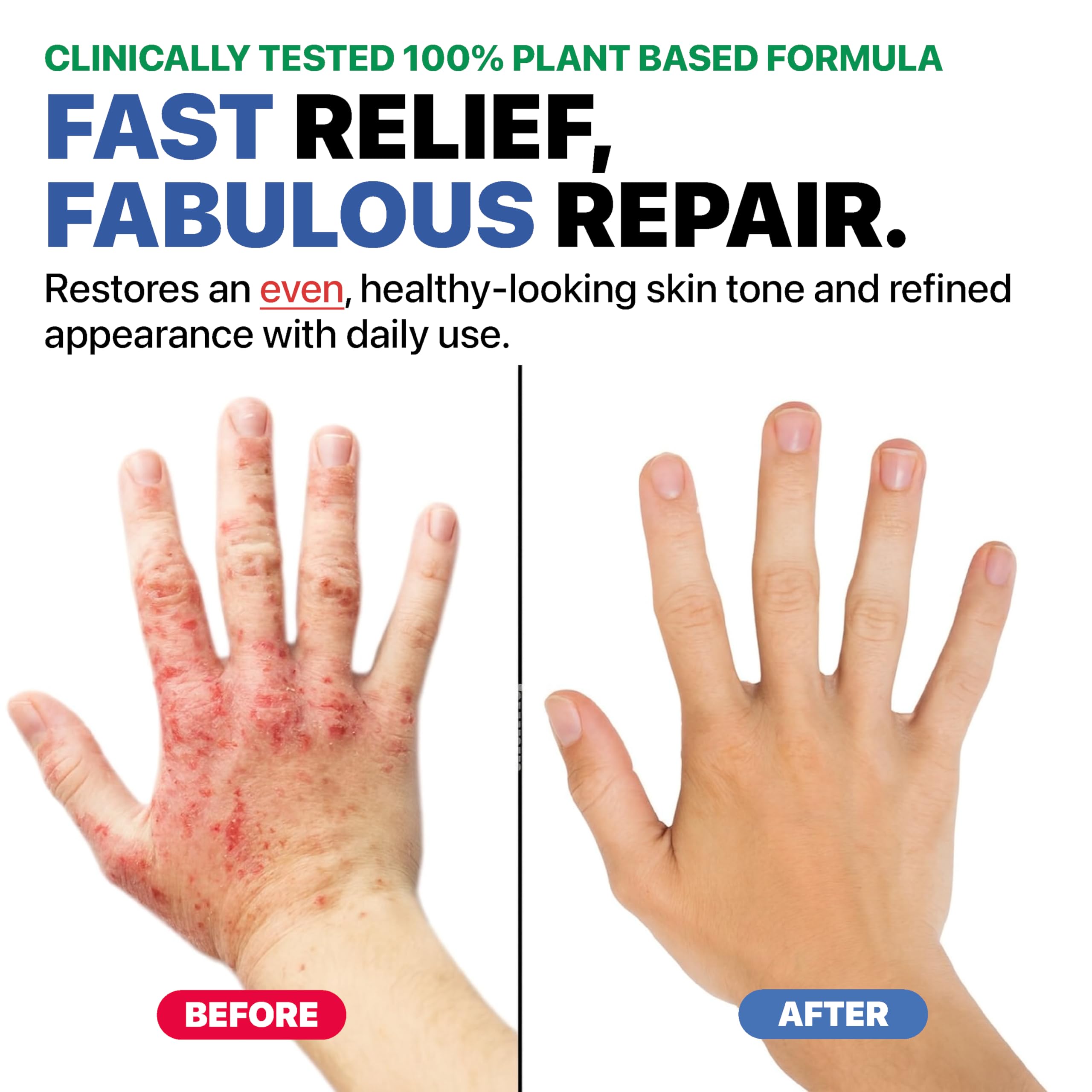 Dr. Arsy Eczema Cream applied to hands.