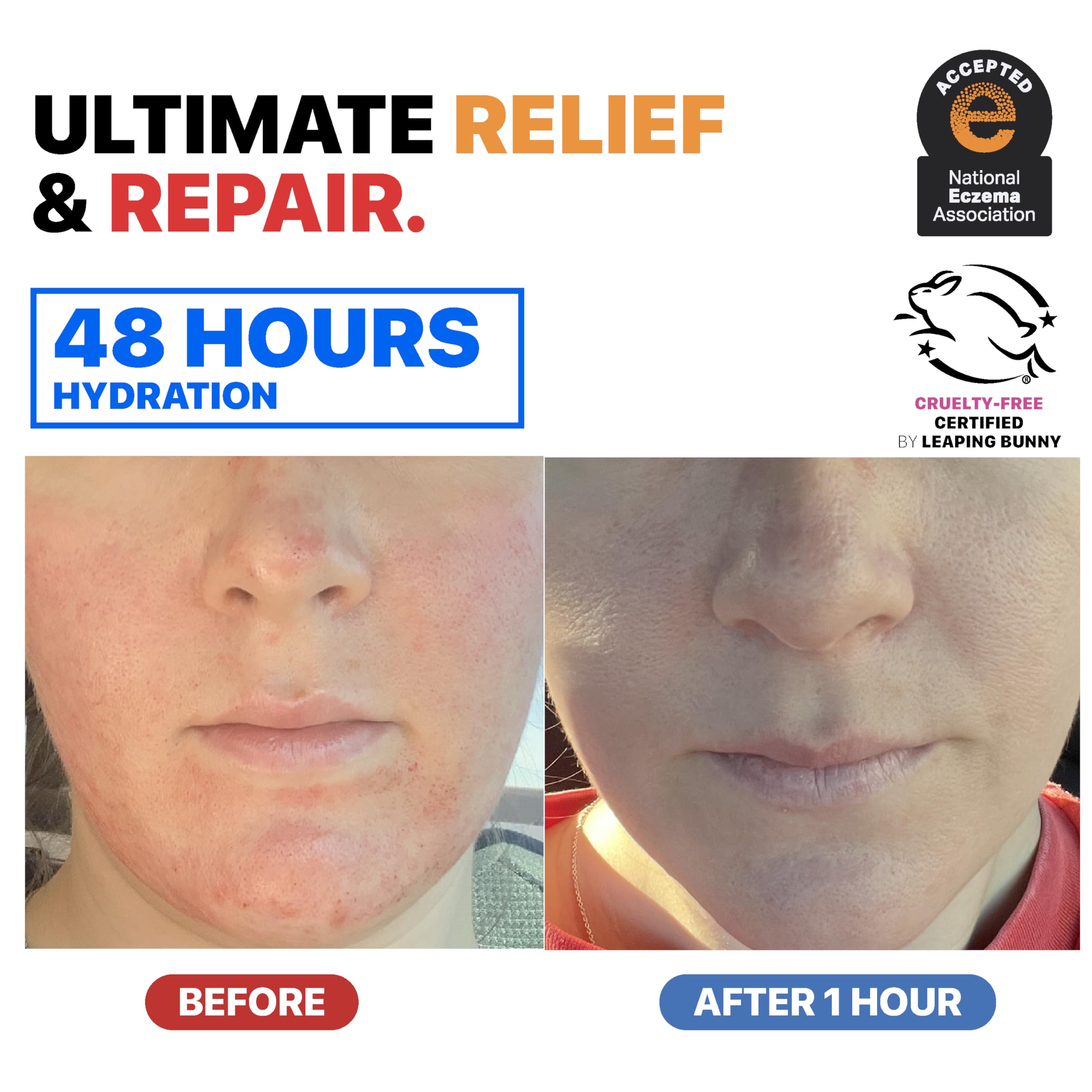 Dr. Arsy Eczema Cream for adults and kids.