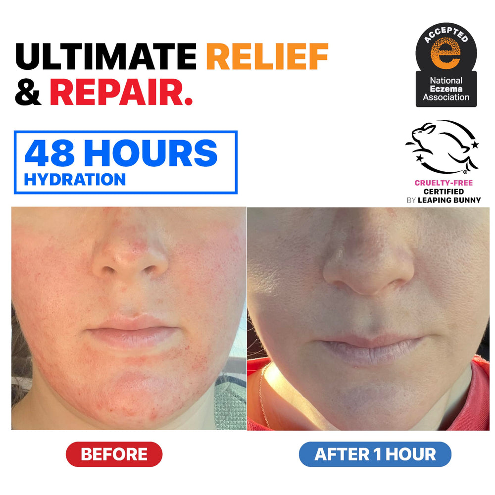 Dr. Arsy Eczema Cream for adults and kids.
