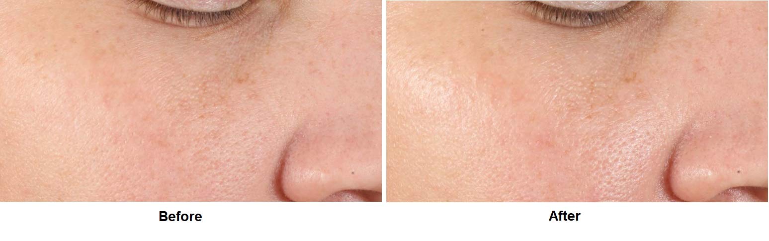 Pores visual demonstrates reduced visibility with regular use of Dr Dennis Gross serum.