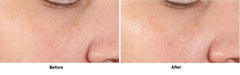 Pores visual demonstrates reduced visibility with regular use of Dr Dennis Gross serum.