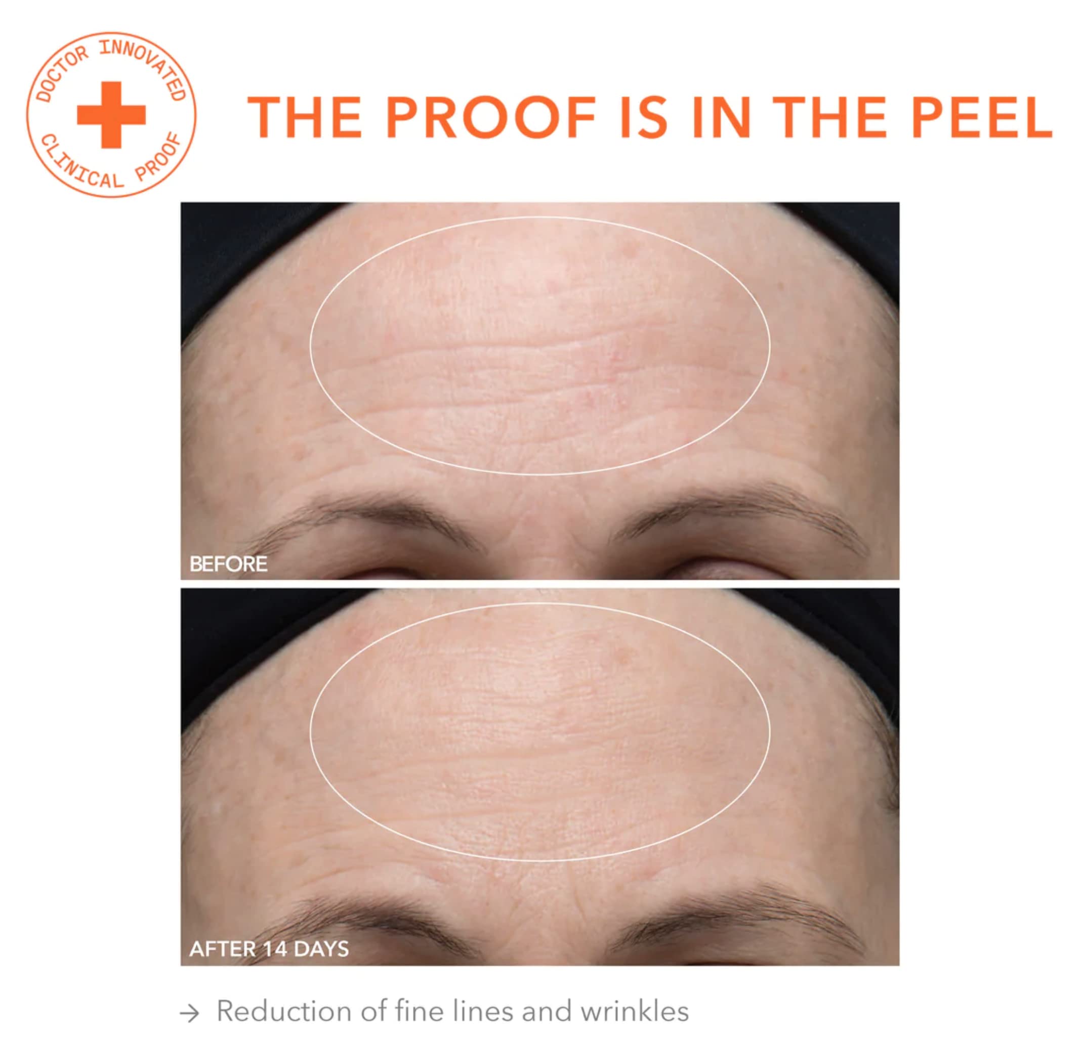 Dr Dennis Gross closeup of pores after treatment demonstrates refinement.